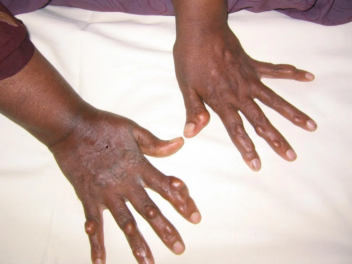 Hypercholesterolemia and familial hypercholesterolemia – clinical photo: Tuberous xanthomas on the hands