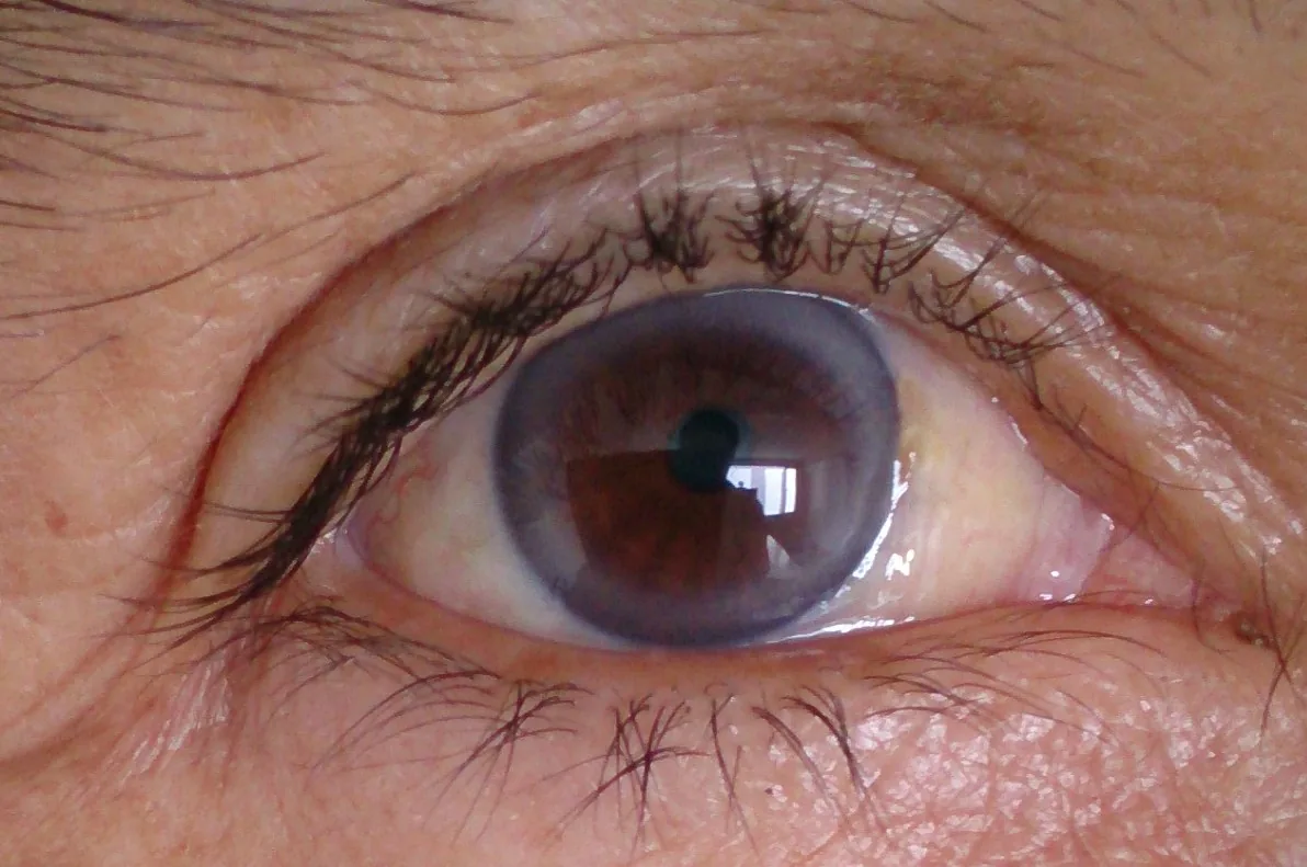 Hypercholesterolemia and familial hypercholesterolemia – clinical photo: Corneal arcus