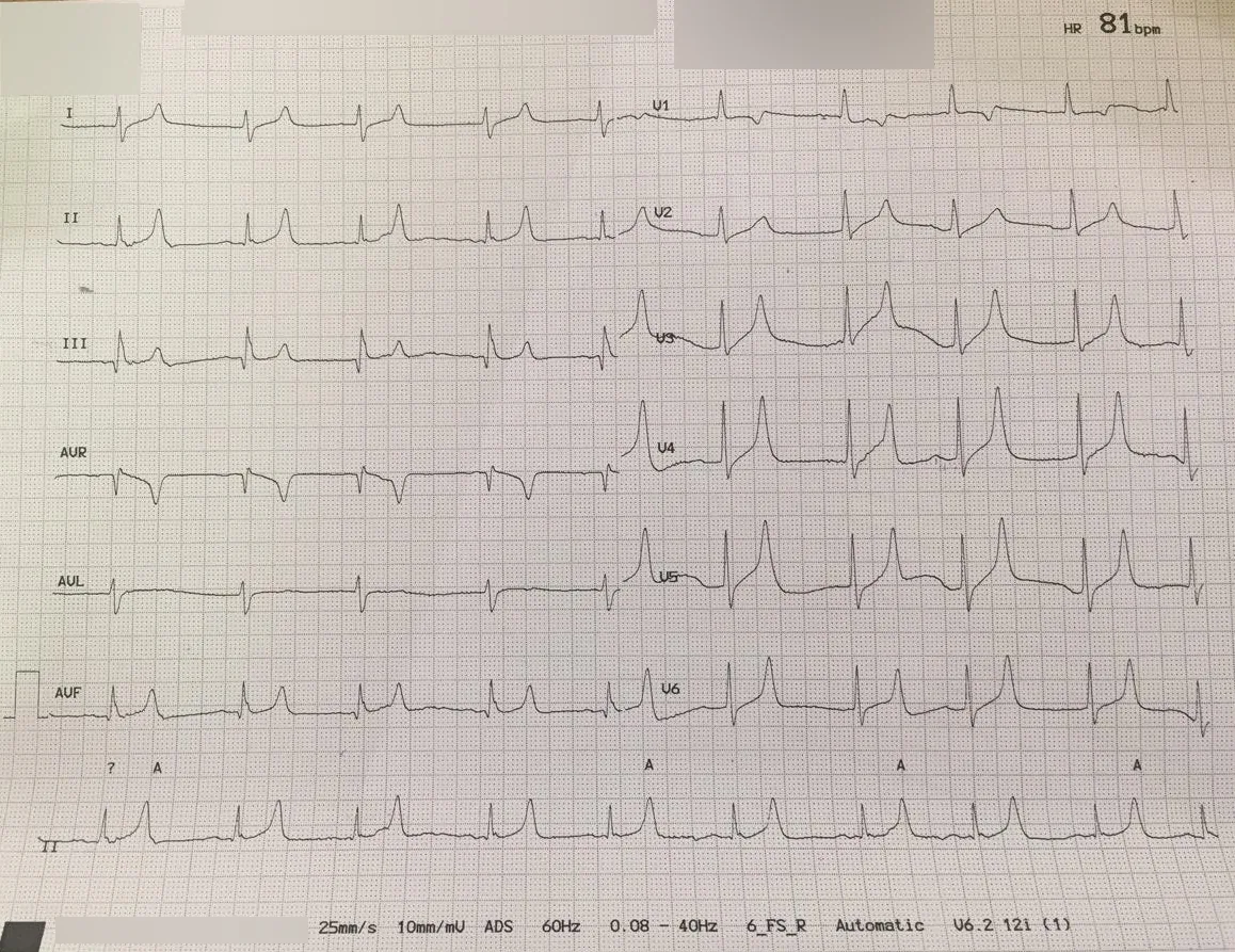 Hyperkalemia – ECG: Tall peaked T waves in hyperkalemia