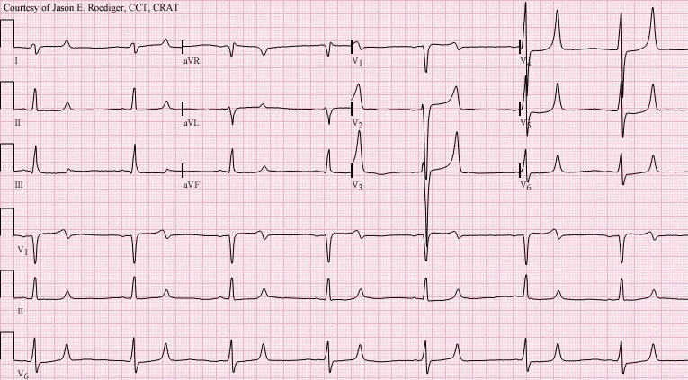 Hyperkalemia – ECG changes in hyperkalemia