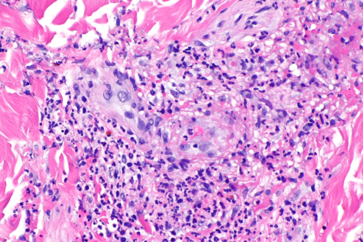 IgA-Vaskulitis (Purpura Schönlein-Henoch) – Histologie: leukozytoklastische Vaskulitis