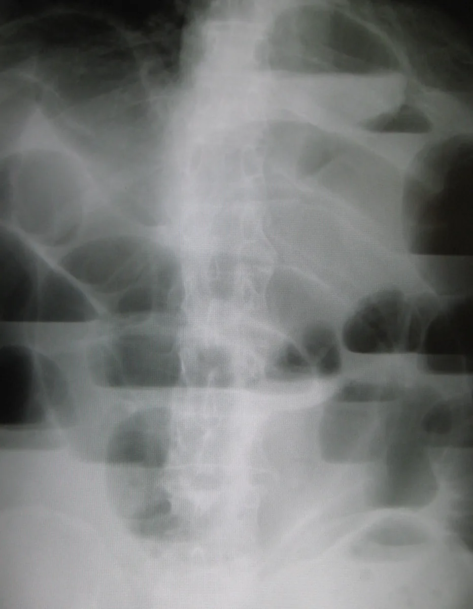 Bowel obstruction (ileus) – Abdominal X-ray: air-fluid levels in bowel obstruction