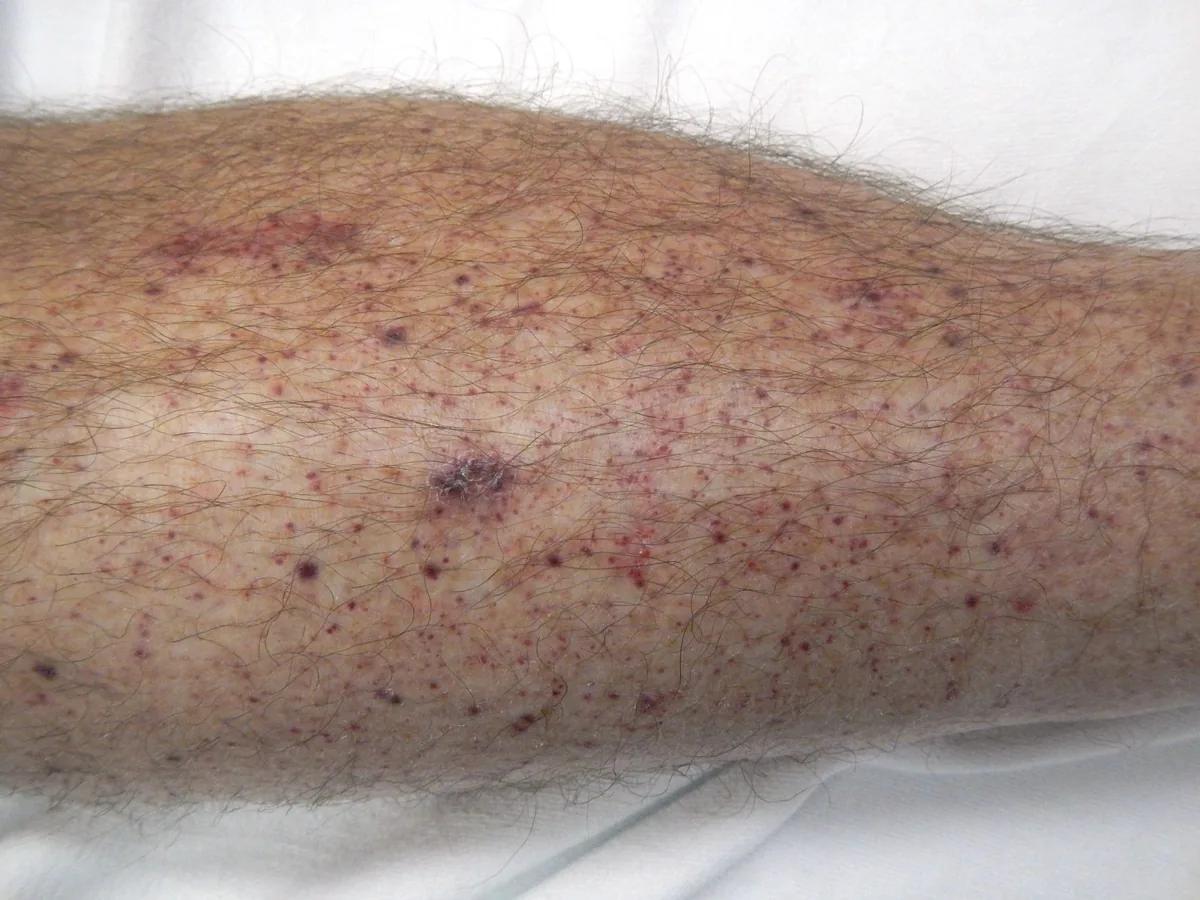 Immune thrombocytopenia (ITP) – clinical photo: Numerous petechiae and small ecchymoses on the lower leg in thrombocytopenia
