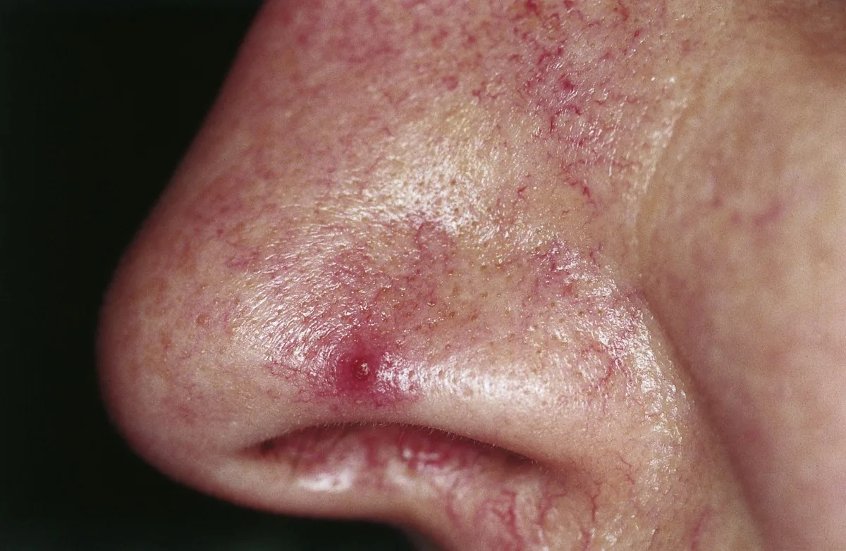 Liver cirrhosis – clinical photo: Spider naevus