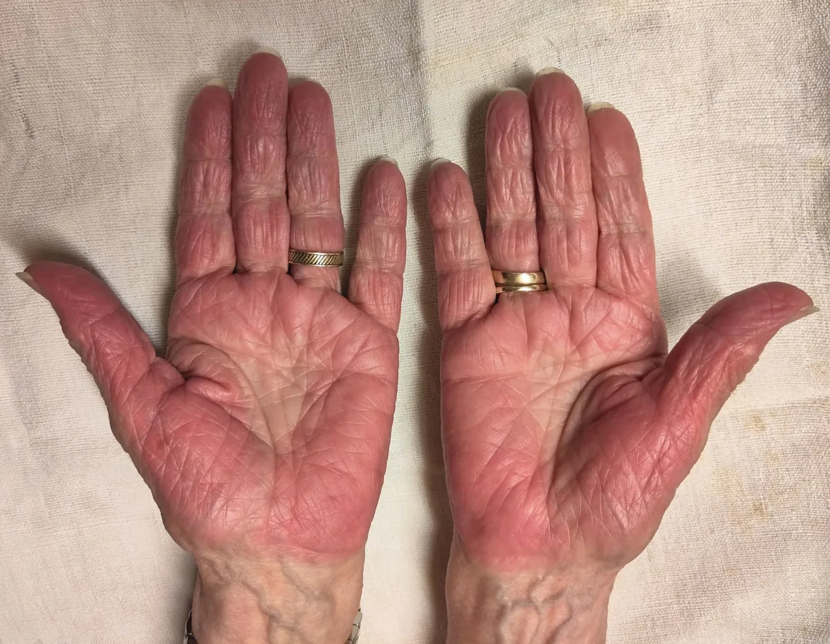 Liver cirrhosis – hand – clinical photo: Palmar erythema