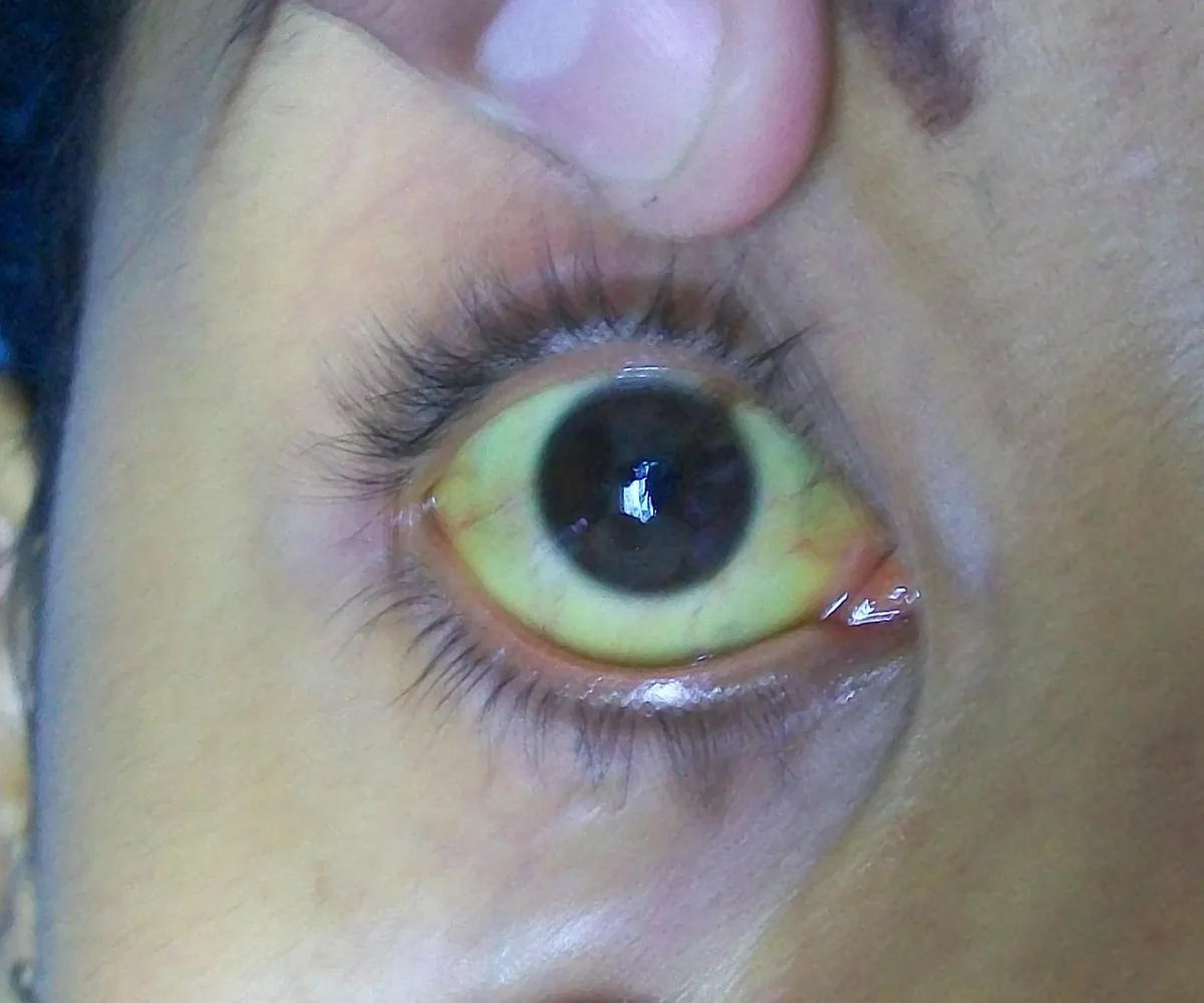 Liver cirrhosis – clinical photo: Scleral icterus
