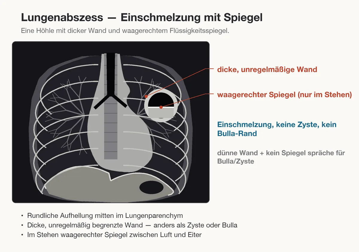 Lungenabszess – Schema (Zeichnung): Zeichnung: Lungenabszess – rundliche Höhle mit dicker, unregelmäßiger Wand und waagerechtem Luft-Flüssigkeits-Spiegel