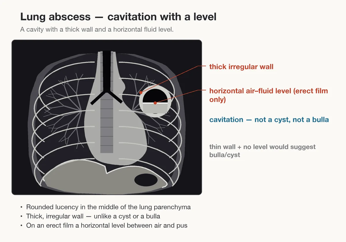 Lung abscess – diagram: Diagram: lung abscess – round cavity with a thick, irregular wall and a horizontal air-fluid level