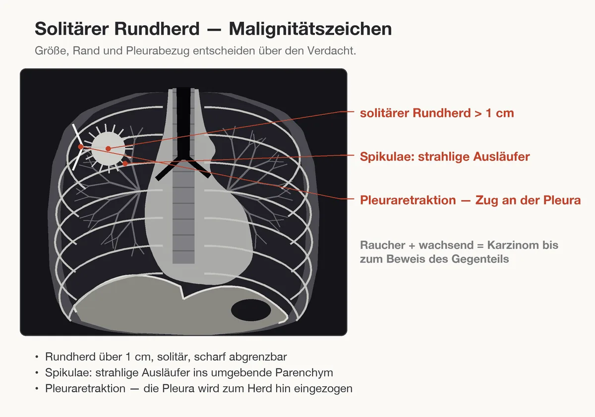 Lungenkarzinom (Bronchialkarzinom, Lungenkrebs) – Schema (Zeichnung): Zeichnung: suspekter solitärer Rundherd – über 1 cm, Spikulae und Pleuraretraktion