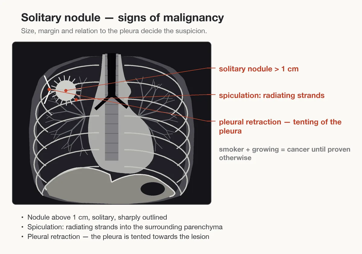 Lung cancer (bronchial carcinoma) – diagram: Diagram: suspicious solitary pulmonary nodule – over 1 cm, spiculated margins and pleural retraction