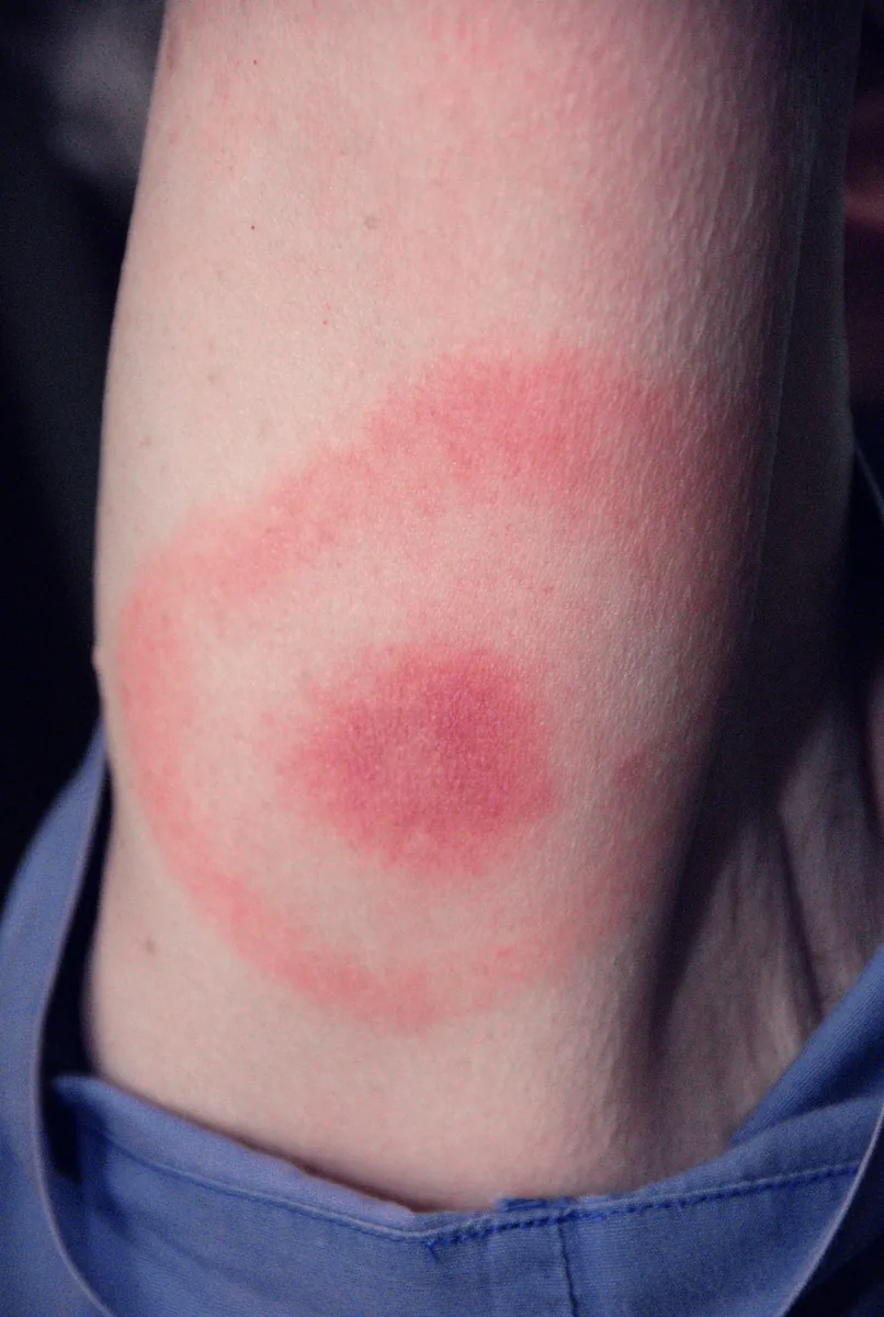 Lyme disease (Lyme borreliosis) – clinical photo: Erythema migrans on the upper arm