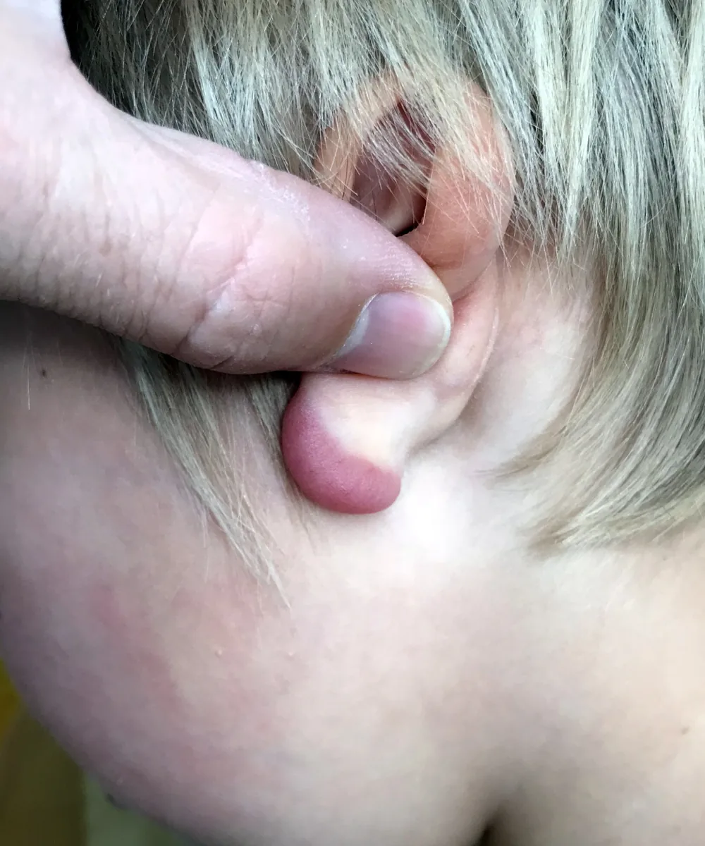 Lyme disease (Lyme borreliosis) – clinical photo: Borrelial lymphocytoma: livid red, soft swelling of the earlobe in a child