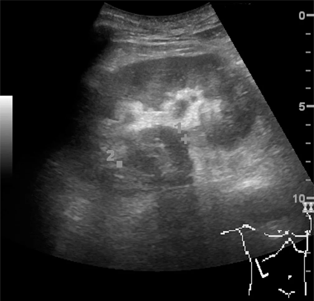 Non-Hodgkin lymphomas – Ultrasound: hypoechoic renal mass due to lymphoma involvement