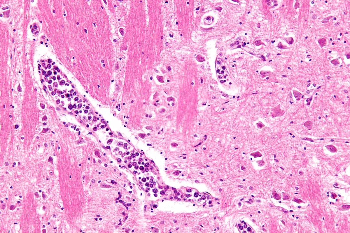 Non-Hodgkin lymphomas – Histology: large atypical B lymphocytes filling a small vessel (intravascular large B-cell lymphoma)