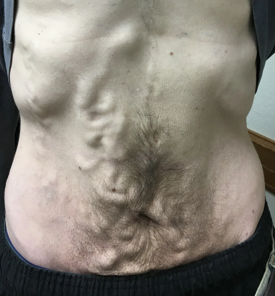 Esophageal varices and portal hypertension – abdomen – clinical photo: Caput medusae: dilated abdominal wall veins