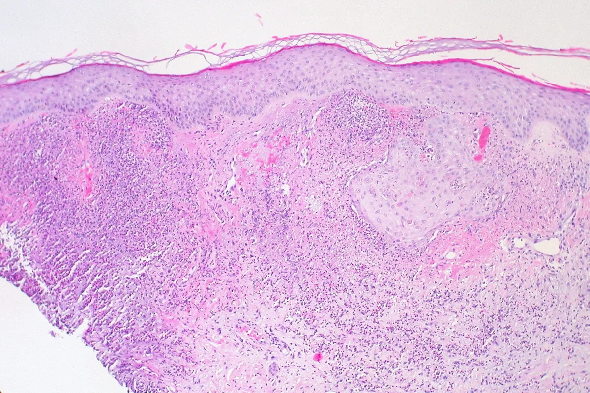 Paraneoplastic syndromes – Histology of Sweet syndrome (acute febrile neutrophilic dermatosis): dense neutrophilic infiltrate and edema of the upper dermis