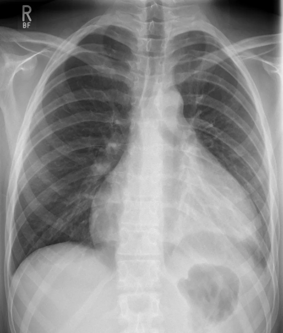 Pericardial effusion and cardiac tamponade – Chest X-ray: enlarged flask-shaped cardiac silhouette in pericardial effusion