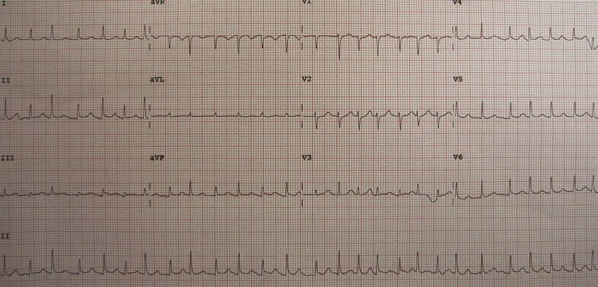 Pericardial effusion and cardiac tamponade – ECG: Electrical alternans in a large pericardial effusion