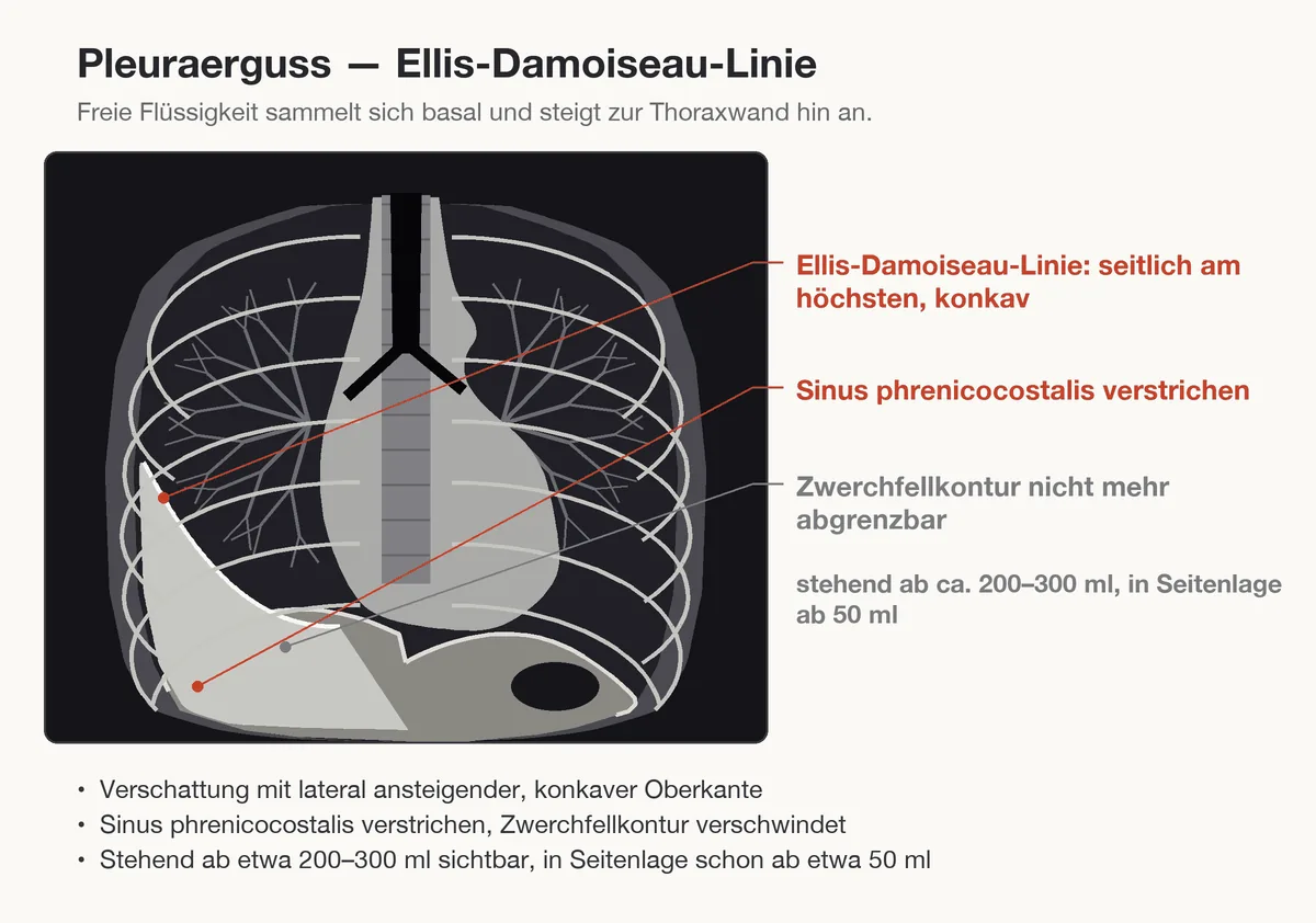 Pleuraerguss – Schema (Zeichnung): Zeichnung: Pleuraerguss – lateral ansteigende, konkave Verschattung (Ellis-Damoiseau-Linie), verstrichener Sinus phrenicocostalis