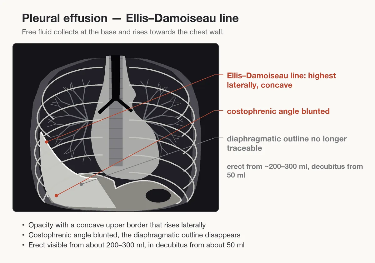 Pleural effusion – diagram: Diagram: pleural effusion – opacity rising laterally with a concave upper border (meniscus sign), blunted costophrenic angle