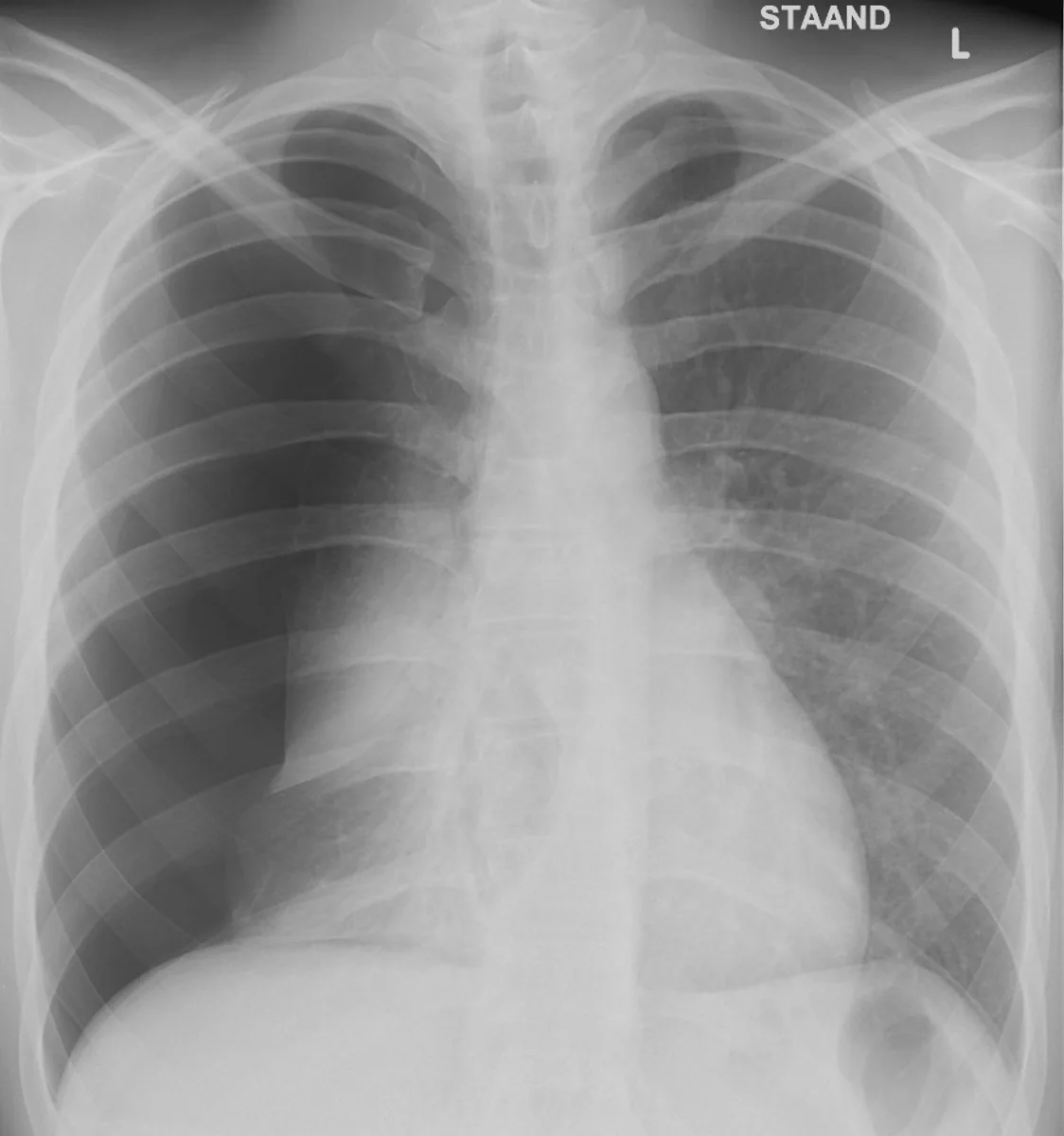 Pneumothorax (collapsed lung) – Chest X-ray: right pneumothorax with visible pleural line