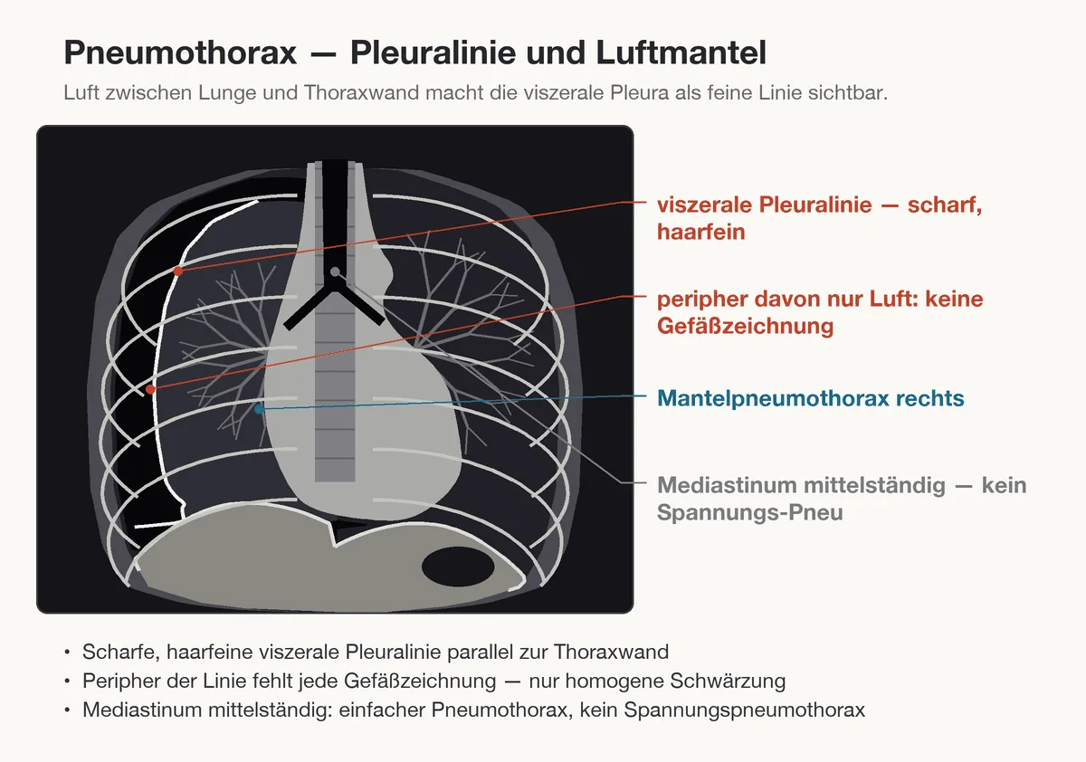 Pneumothorax (Lungenkollaps) – Schema (Zeichnung): Zeichnung: Pneumothorax – haarfeine viszerale Pleuralinie, peripher davon keine Gefäßzeichnung, Mediastinum mittelständig