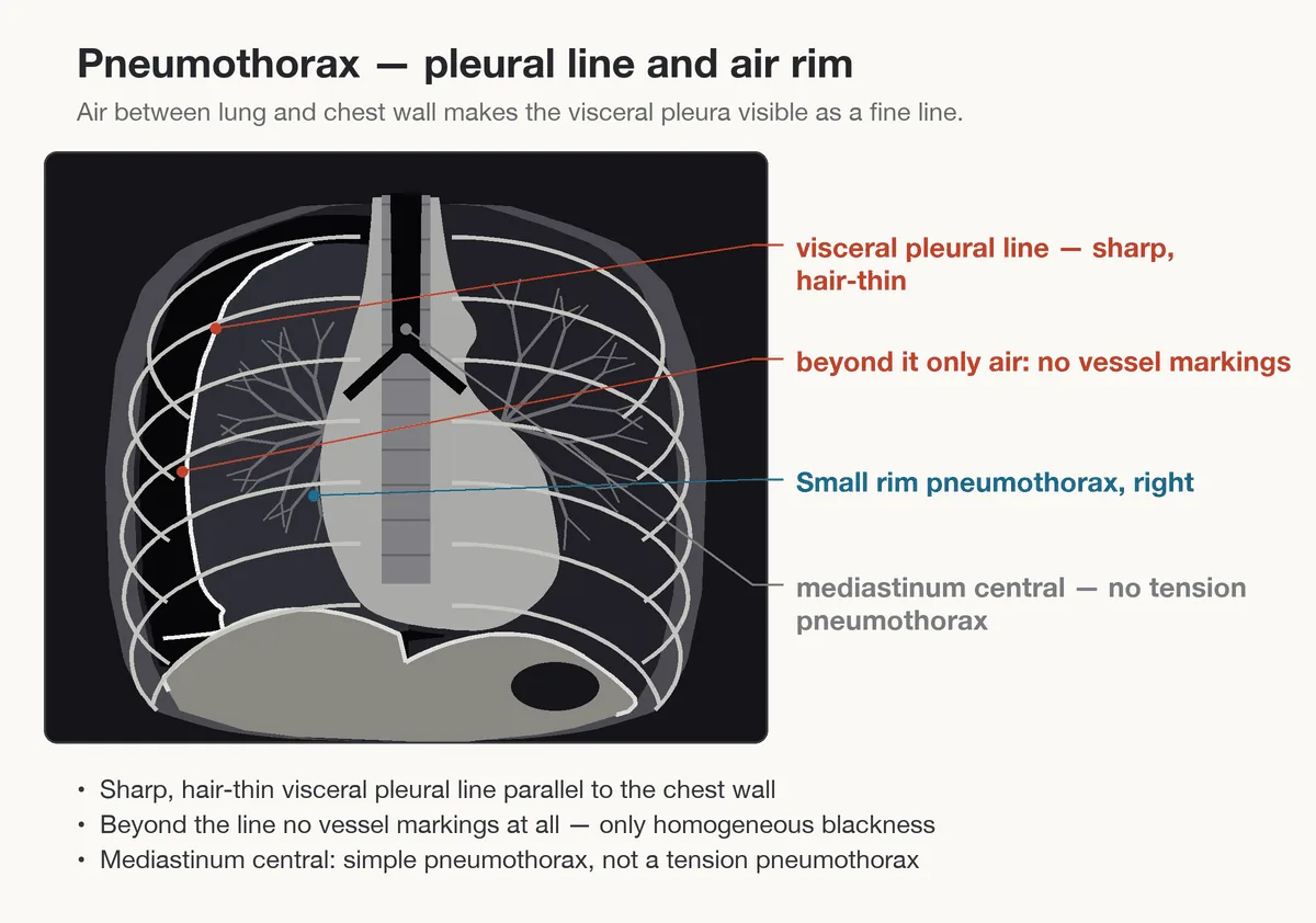 Pneumothorax (collapsed lung) – diagram: Diagram: pneumothorax – hairline visceral pleural line with no vascular markings beyond it, midline mediastinum