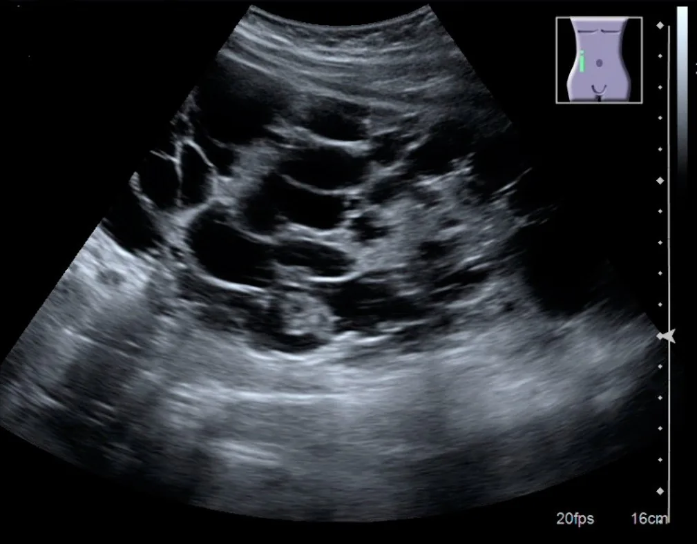 Autosomal dominant polycystic kidney disease (ADPKD) – Ultrasound: enlarged kidney with numerous cysts