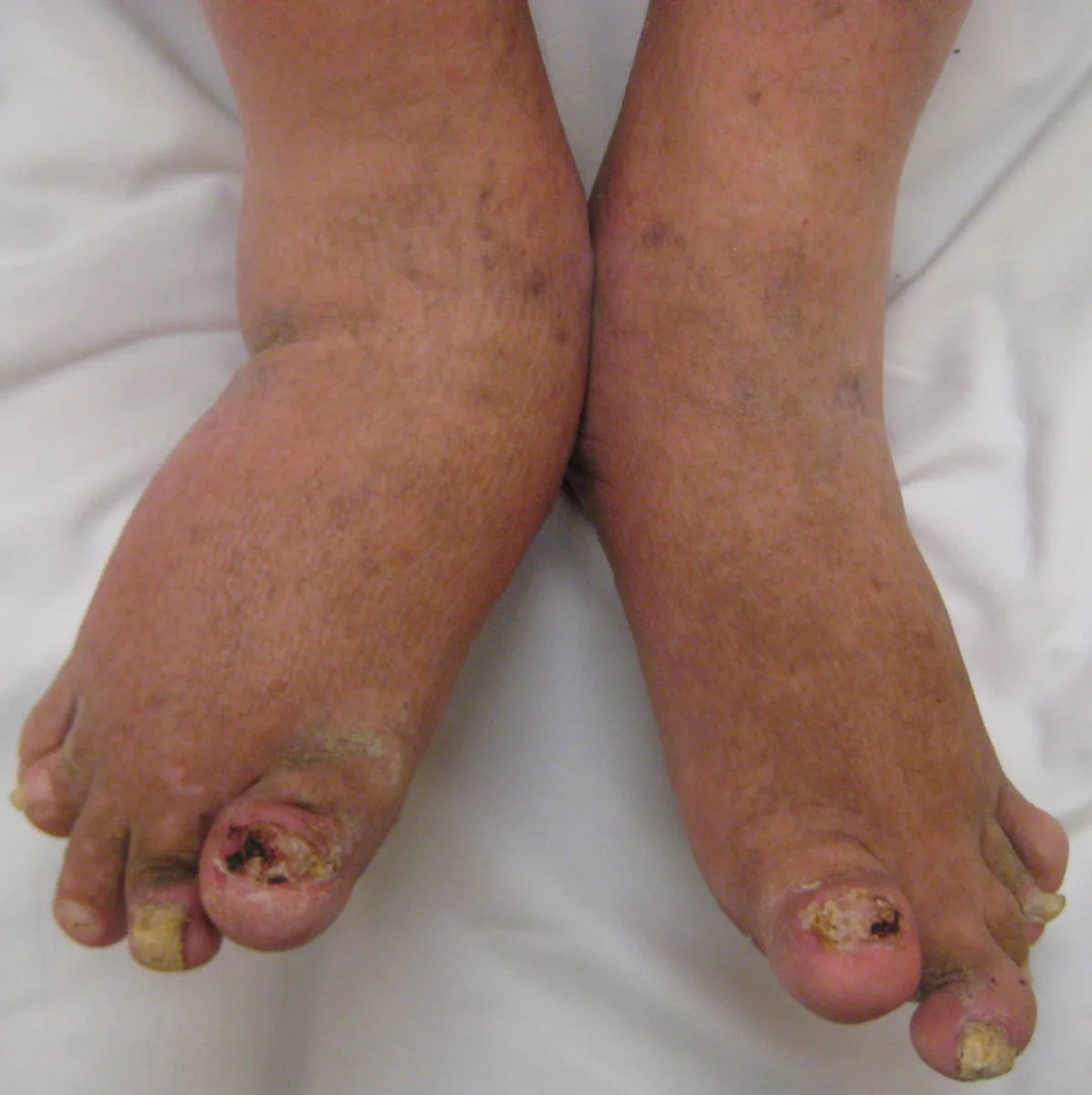 Psoriatic arthritis – clinical photo: Psoriatic arthritis of the foot