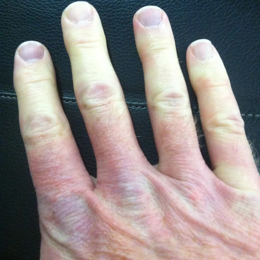 Raynaud's phenomenon – clinical photo: Raynaud attack: fingers sharply demarcated white and pale, livid and reddened on the back of the hand (tricolor phenomenon)
