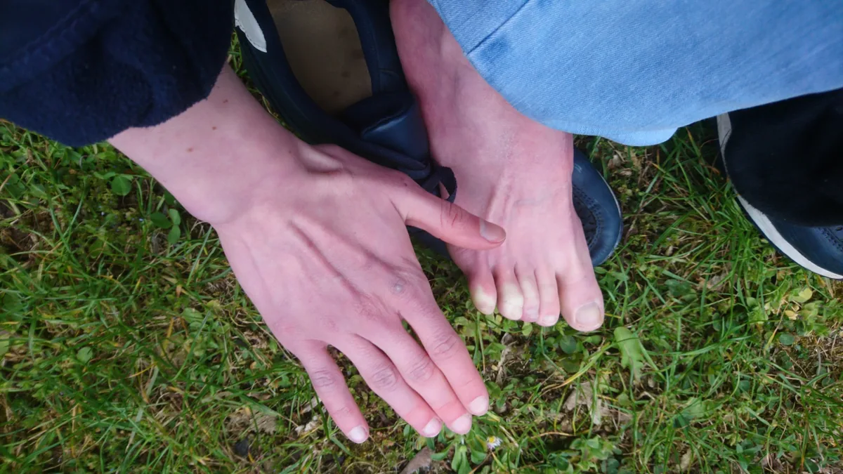 Raynaud's phenomenon – clinical photo: Raynaud's phenomenon in fingers and toes at the same time: blanched white acral parts in the cold