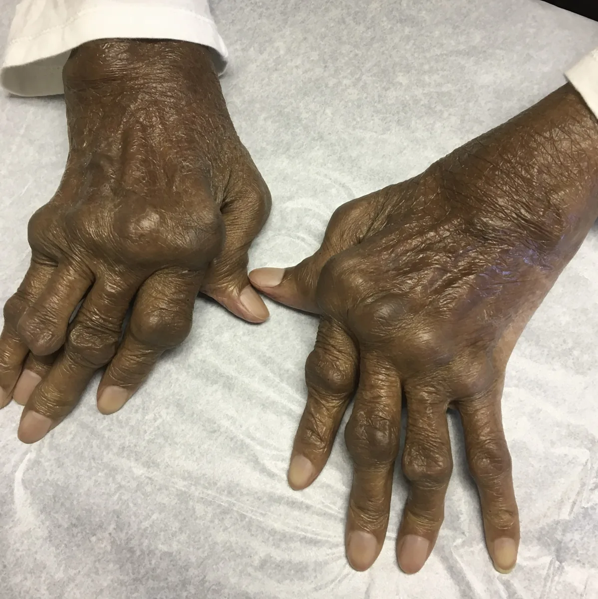 Rheumatoid arthritis – clinical photo: Hand in advanced rheumatoid arthritis