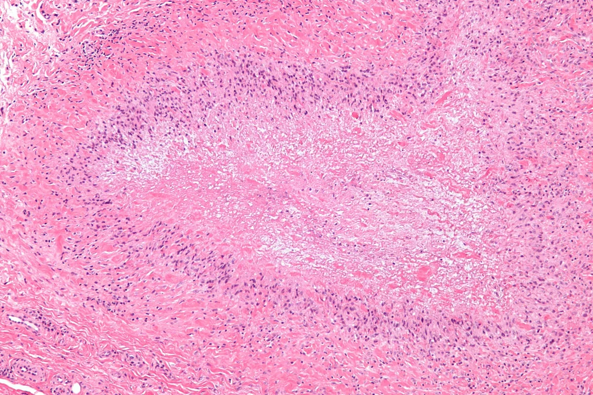 Rheumatoid arthritis – Histology of a rheumatoid nodule