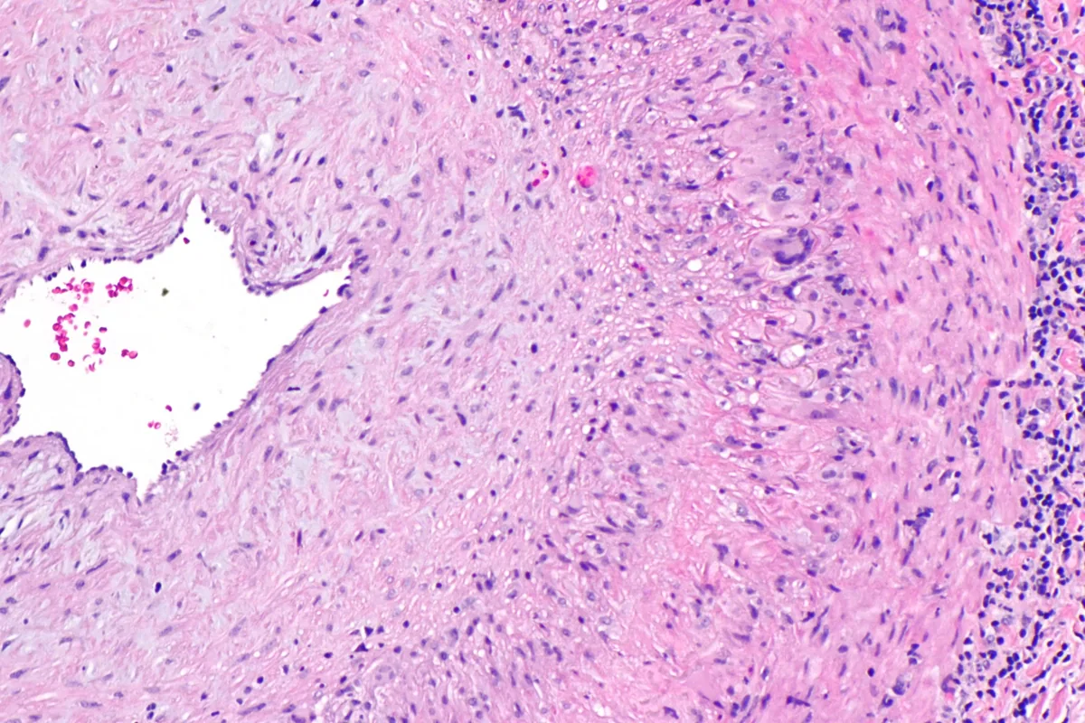 Giant cell arteritis (temporal arteritis) – Temporal artery biopsy (H&E): intimal thickening with narrowed lumen and inflammatory infiltrate of the vessel wall
