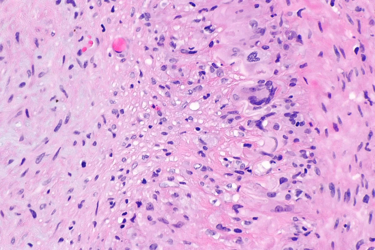 Giant cell arteritis (temporal arteritis) – Giant cell arteritis (H&E, high power): multinucleated giant cells and lymphocytes in the arterial wall