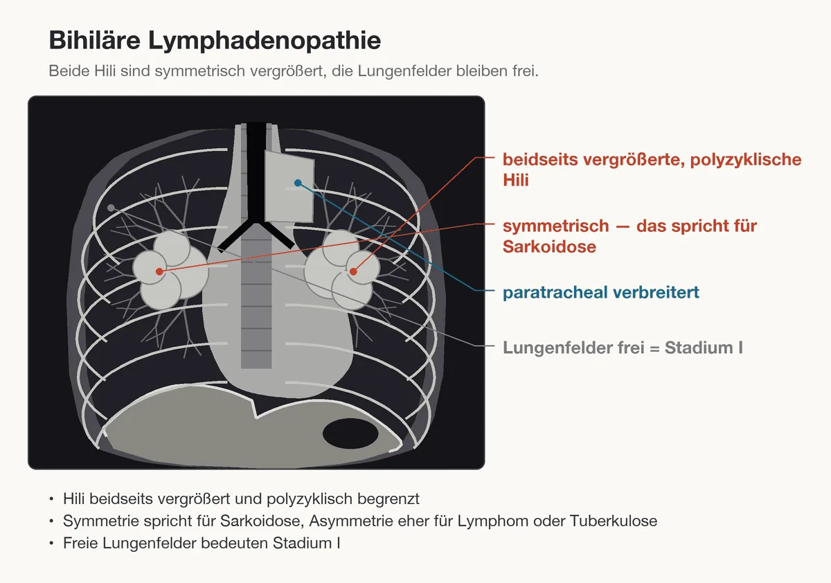 Sarkoidose – Schema (Zeichnung)
