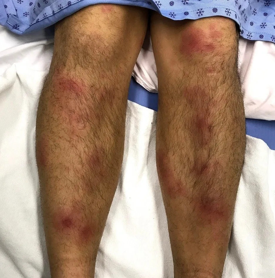Sarcoidosis – clinical photo: Erythema nodosum on the lower leg