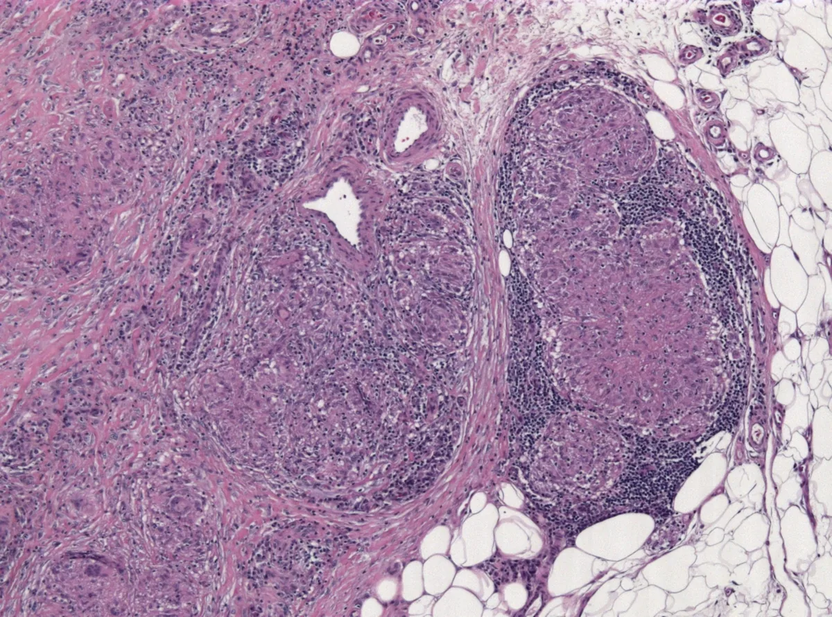 Sarcoidosis – Histology: non-caseating epithelioid granulomas