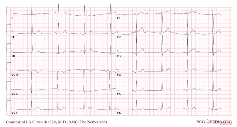 Sick sinus syndrome – ECG: Sinus bradycardia on ECG