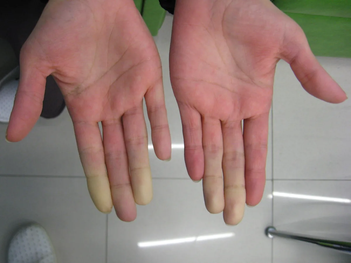 Sjögren's syndrome – clinical photo: Secondary Raynaud's phenomenon in Sjögren's syndrome: several fingers of both hands sharply demarcated and pale
