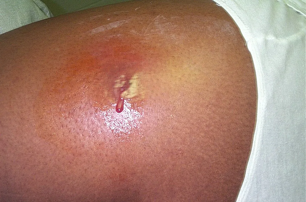 Staphylococcus aureus bacteremia – clinical photo: Skin abscess caused by Staphylococcus aureus