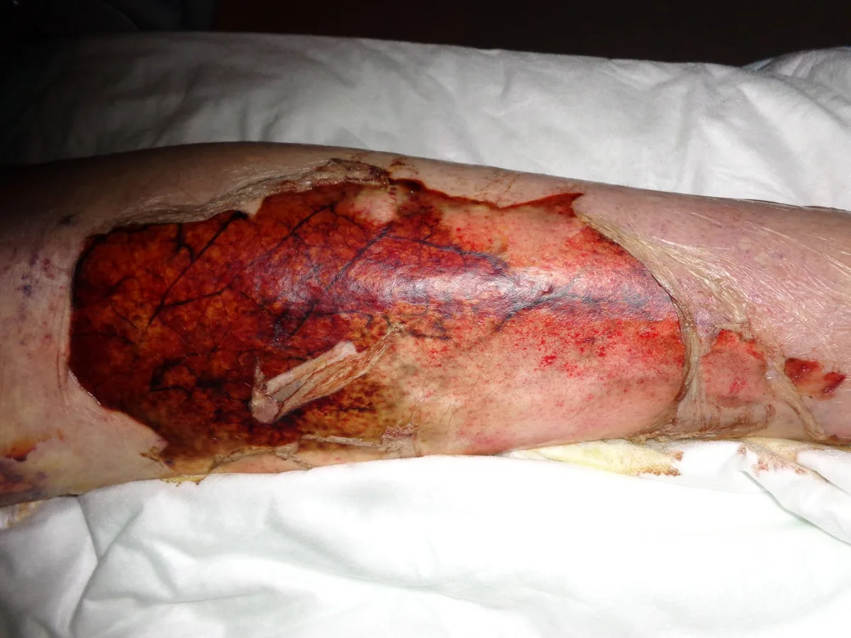Stevens-Johnson syndrome and toxic epidermal necrolysis – clinical photo: Epidermal detachment in SJS/TEN