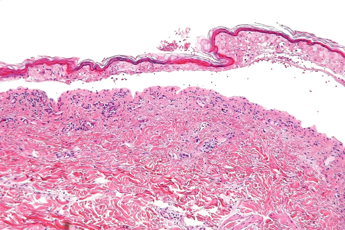 Stevens-Johnson syndrome and toxic epidermal necrolysis – Histology: epidermal necrosis
