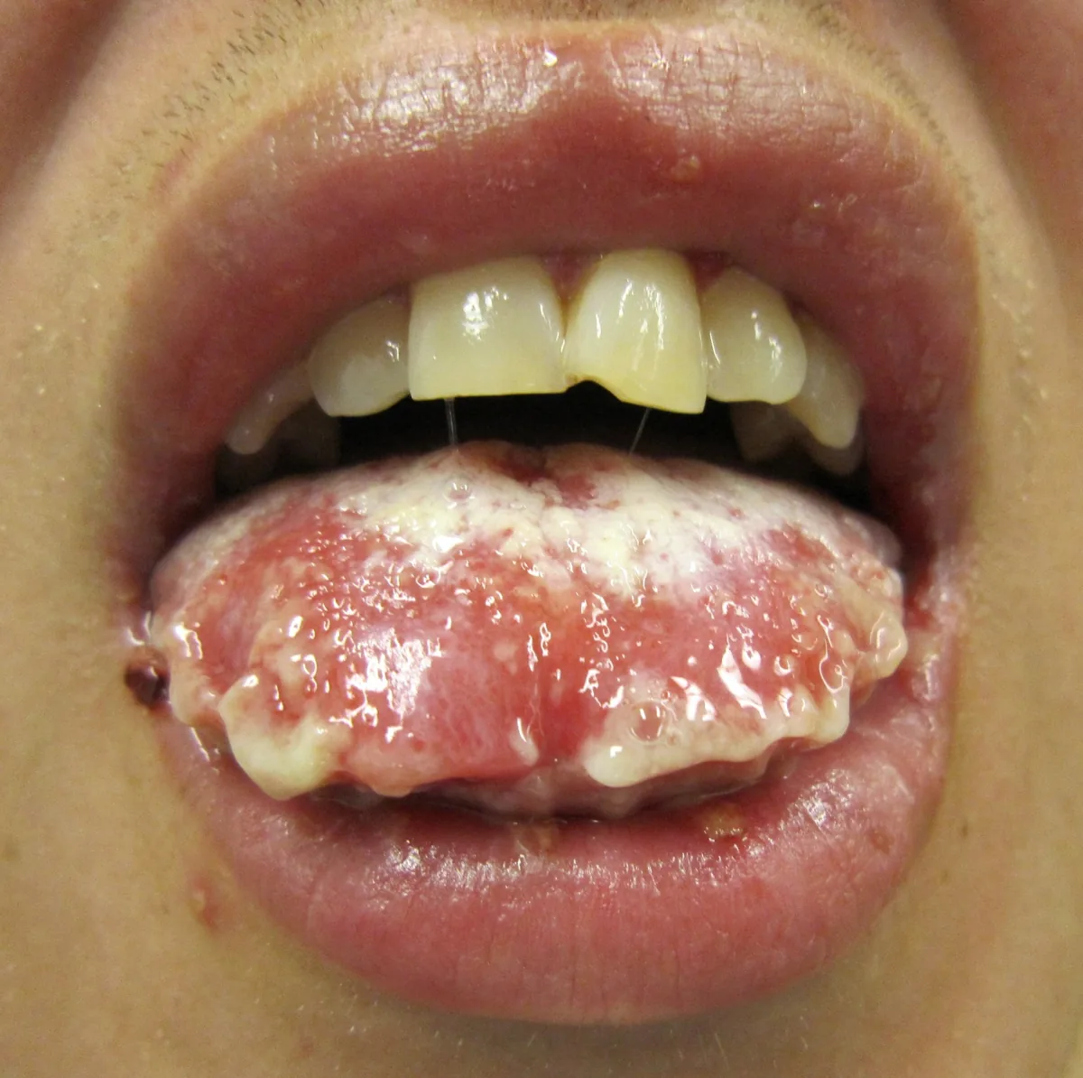 Stevens-Johnson syndrome and toxic epidermal necrolysis – mouth – clinical photo: Mucosal involvement in Stevens–Johnson syndrome: eroded tongue with whitish coating and crusted lips