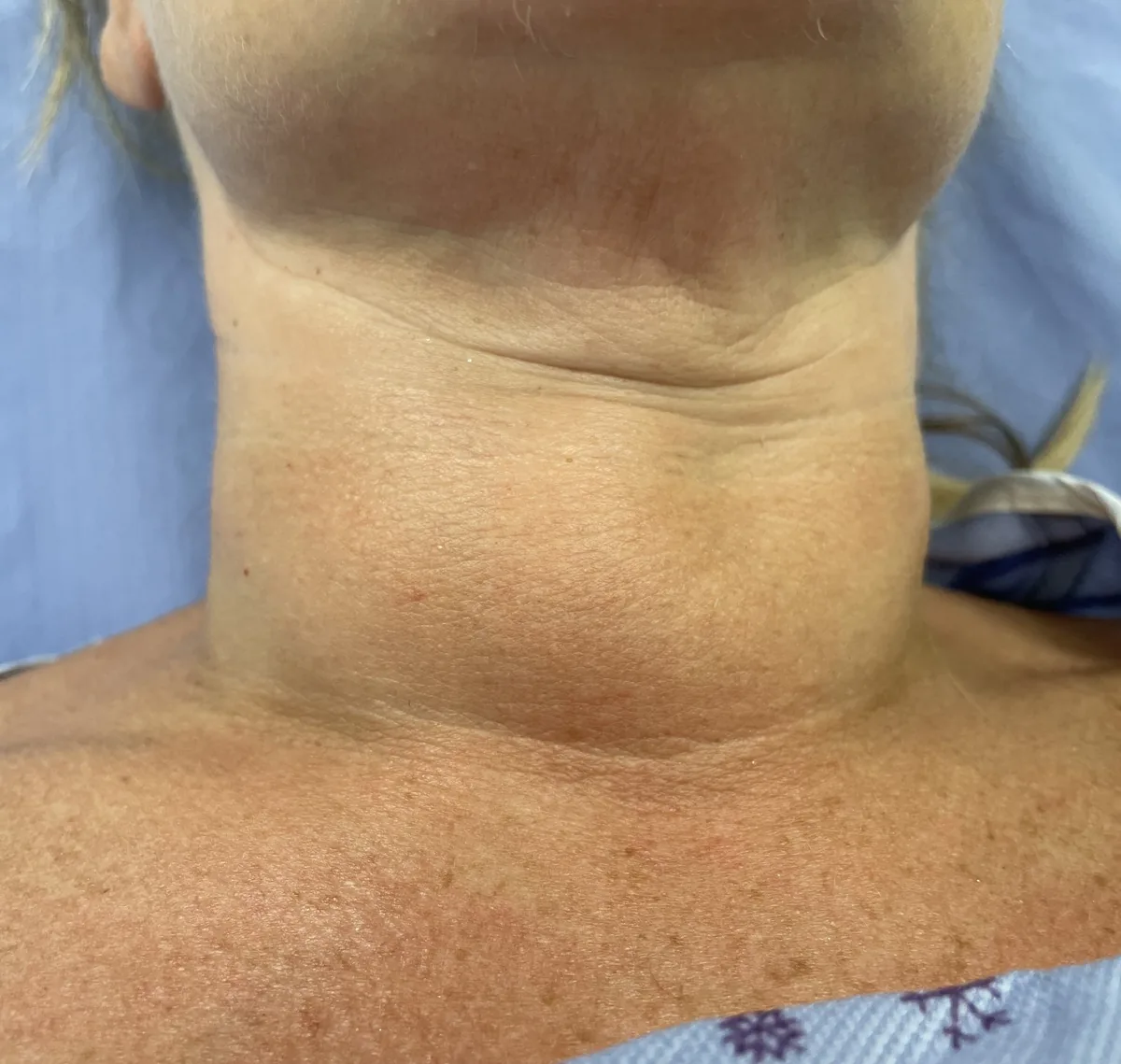 Goiter and thyroid nodules (goitre) – clinical photo: Goiter: marked, broad-based swelling on the front of the neck