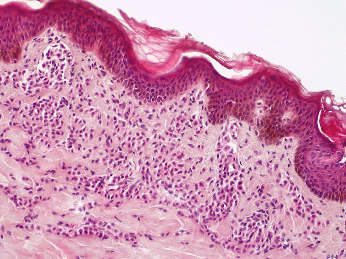 Systemic mastocytosis – Histology: mast cell infiltrate