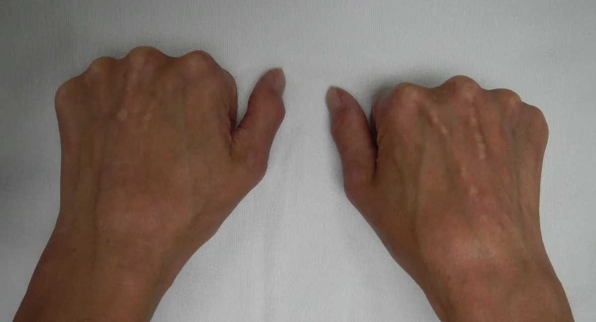 Systemic sclerosis (scleroderma) – clinical photo: Sclerodactyly