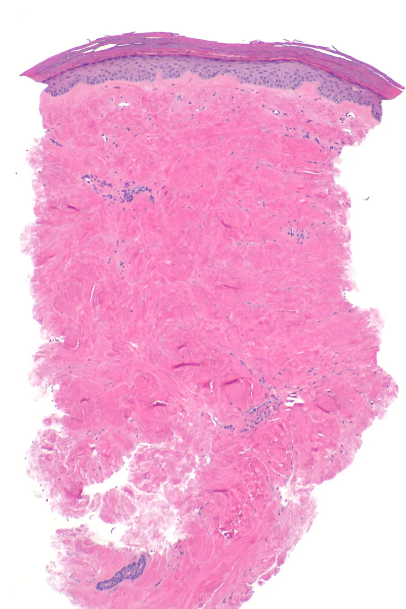 Systemic sclerosis (scleroderma) – Histology: dermal collagen sclerosis