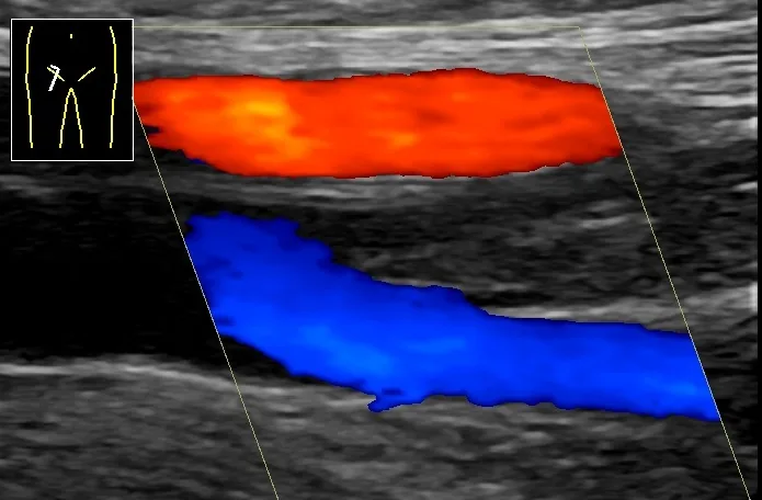 Deep vein thrombosis (blood clot in the leg) – Ultrasound: thrombus in the femoral vein