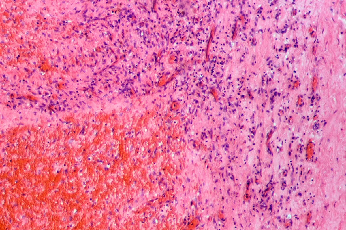 Deep vein thrombosis (blood clot in the leg) – Histology of a venous thrombus